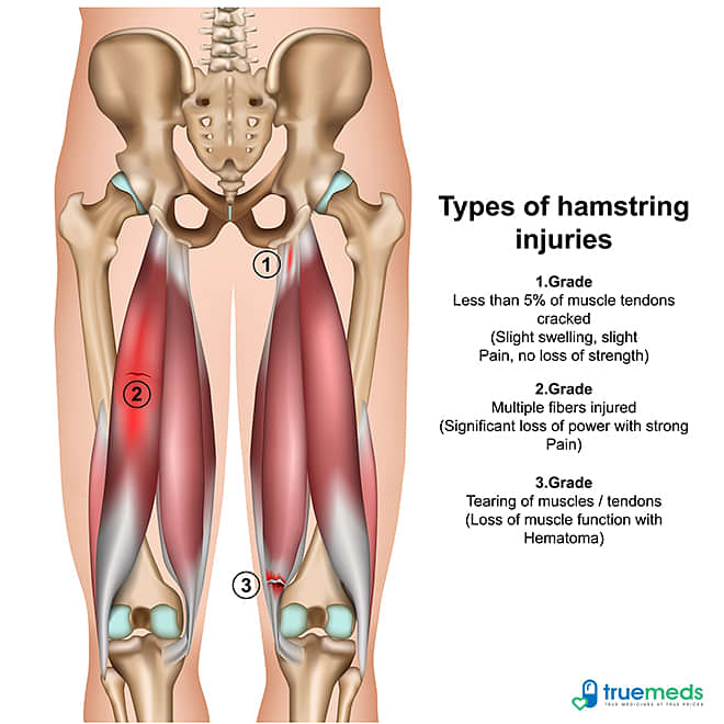 Types-of-hamstring-injurys