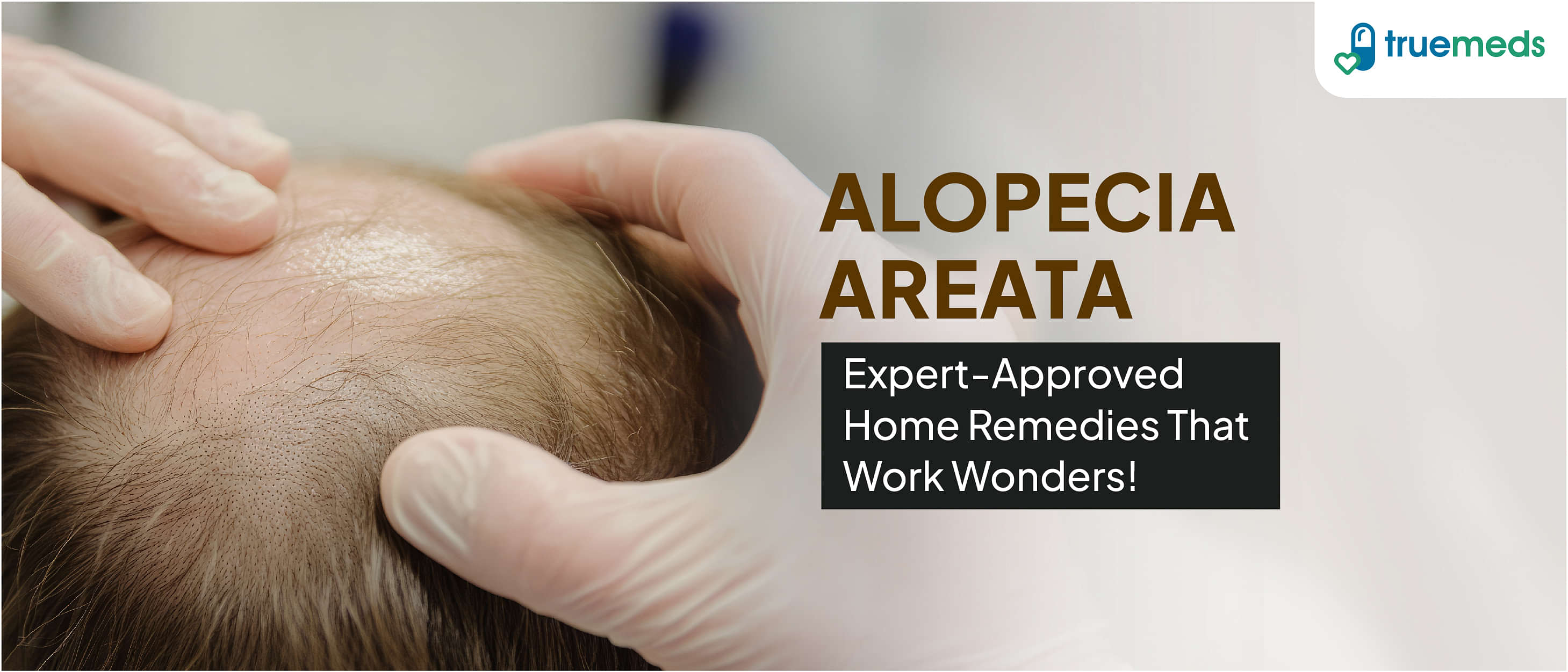 Alopecia Areata Home Remedies You Should Try