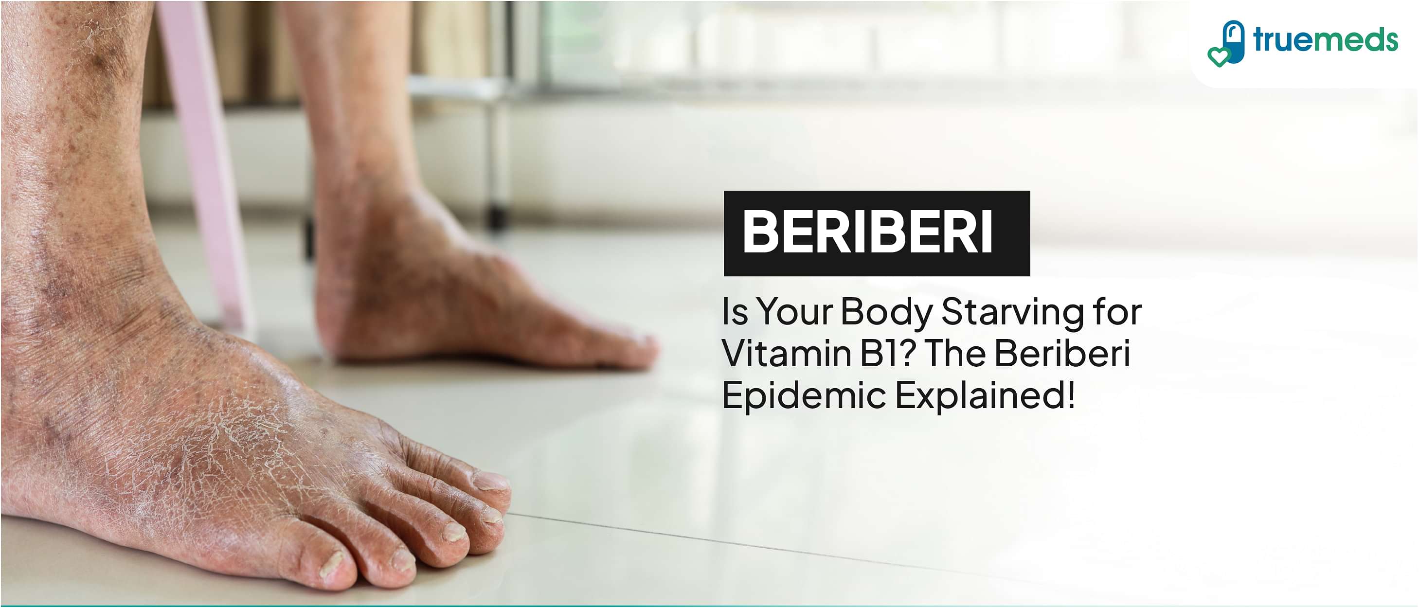 Beriberi Disease: Symptoms, Causes, and Treatment