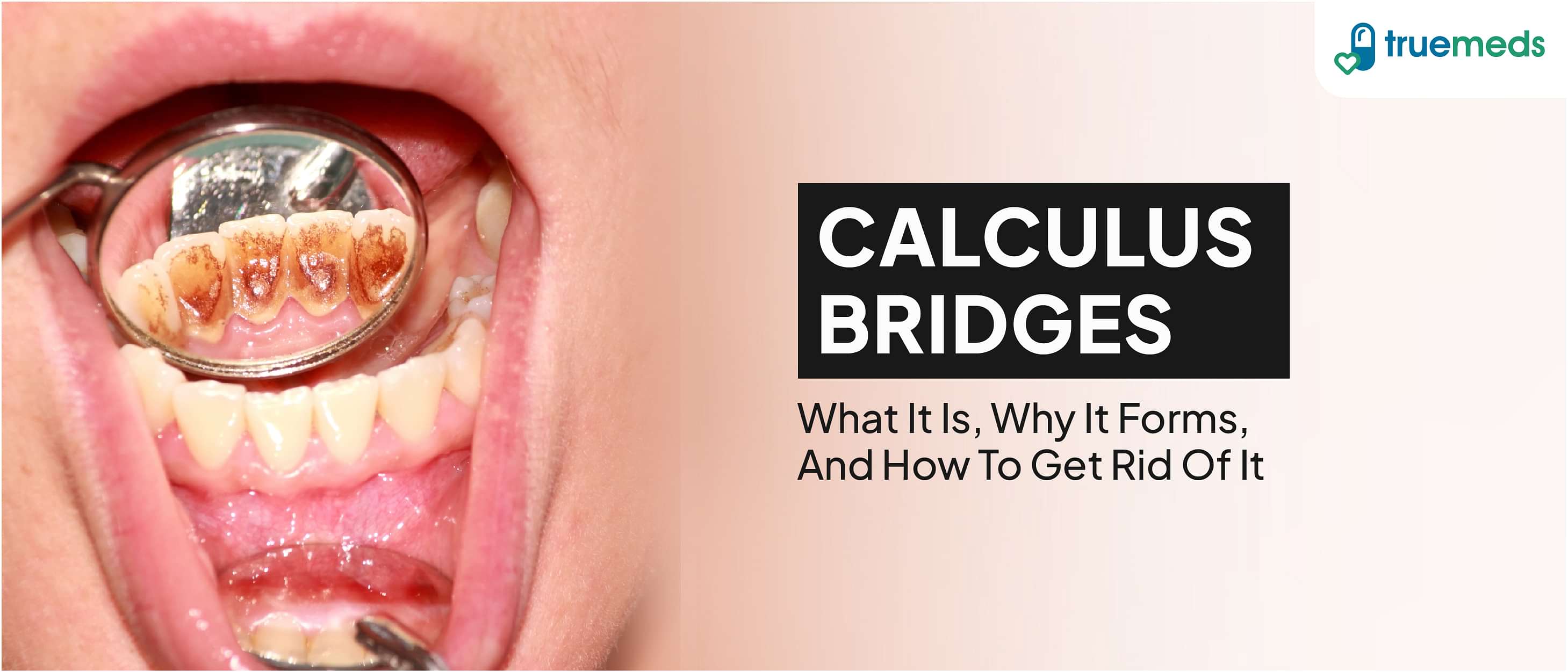 Calculus Bridge: Causes, Treatment, Prevention and Side Effects