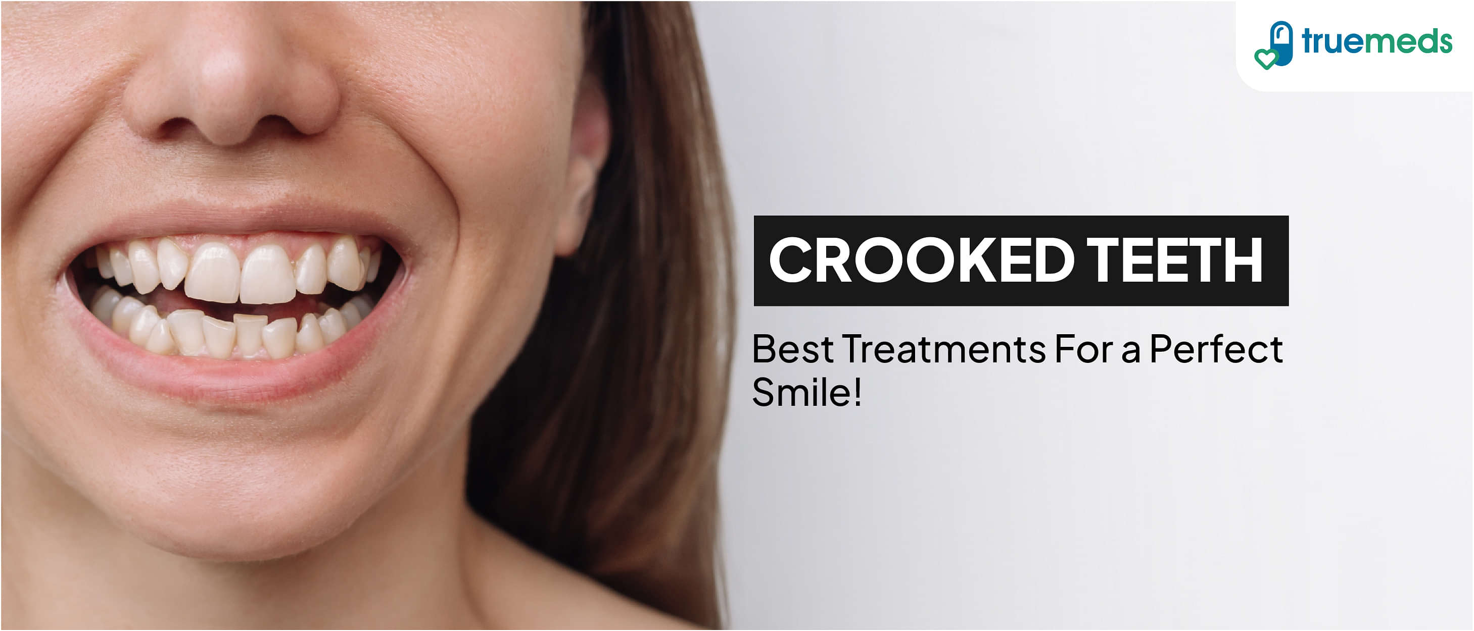 Crooked Teeth: Causes, Treatment, and Prevention Tips