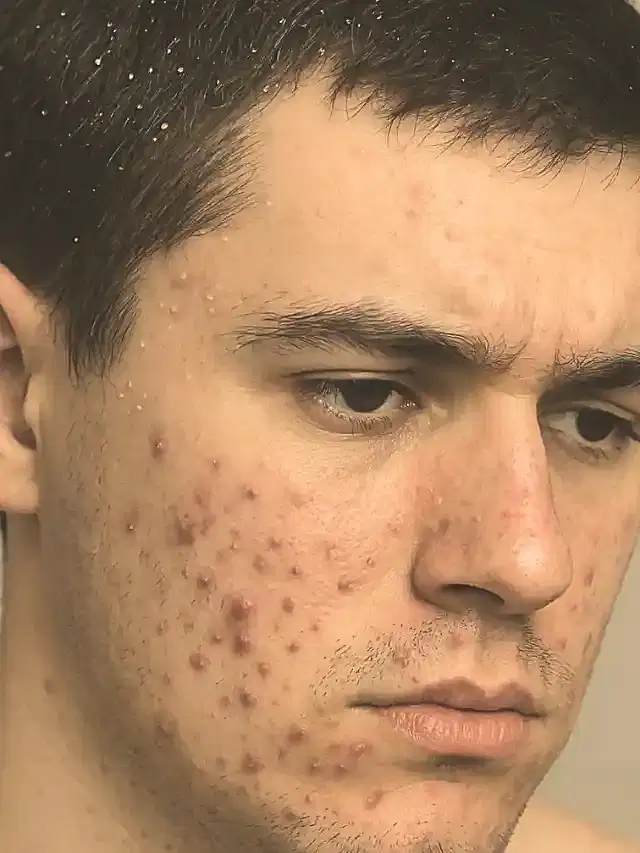 Can Dandruff Cause Acne?