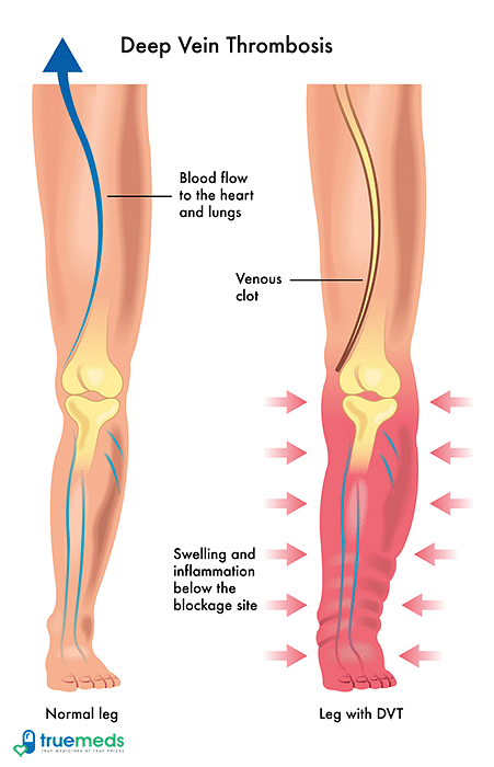 Deep Vein Thrombosis