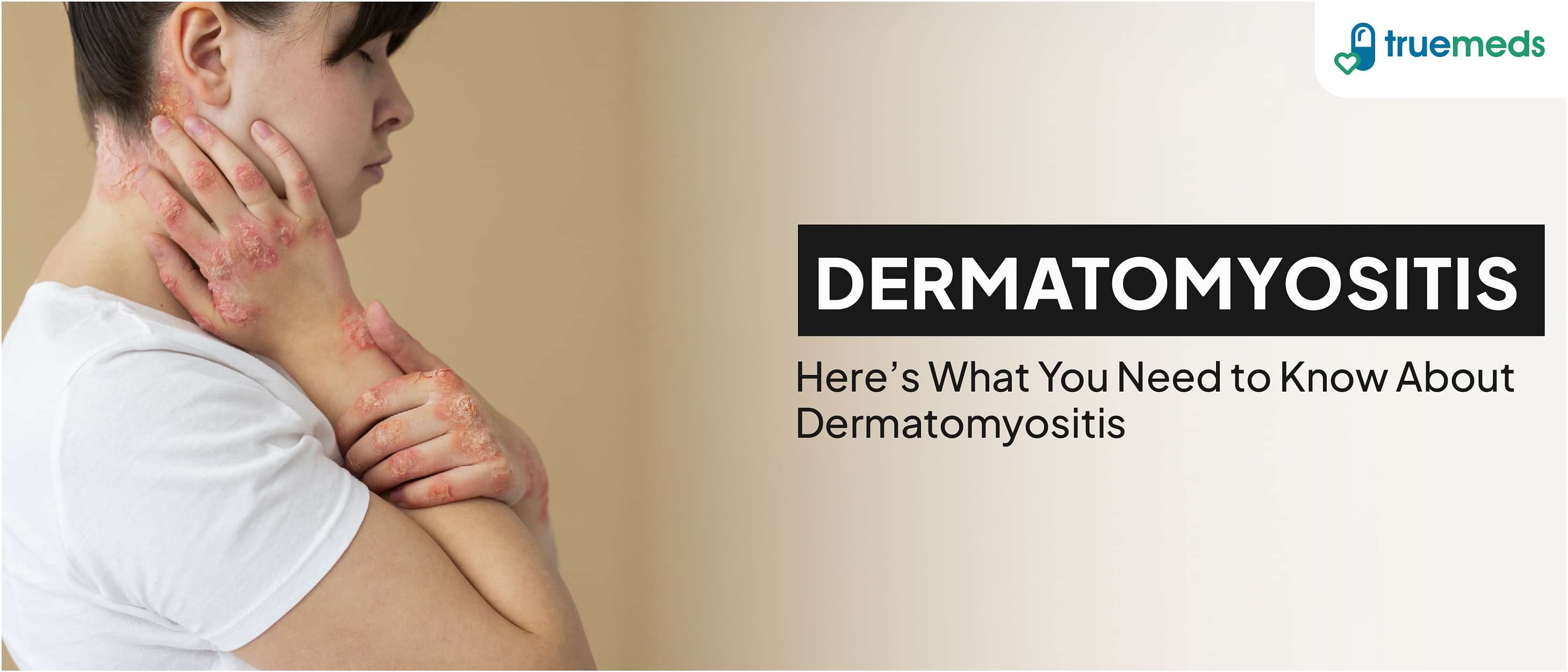 Dermatomyositis: Symptoms, Causes and Treatments