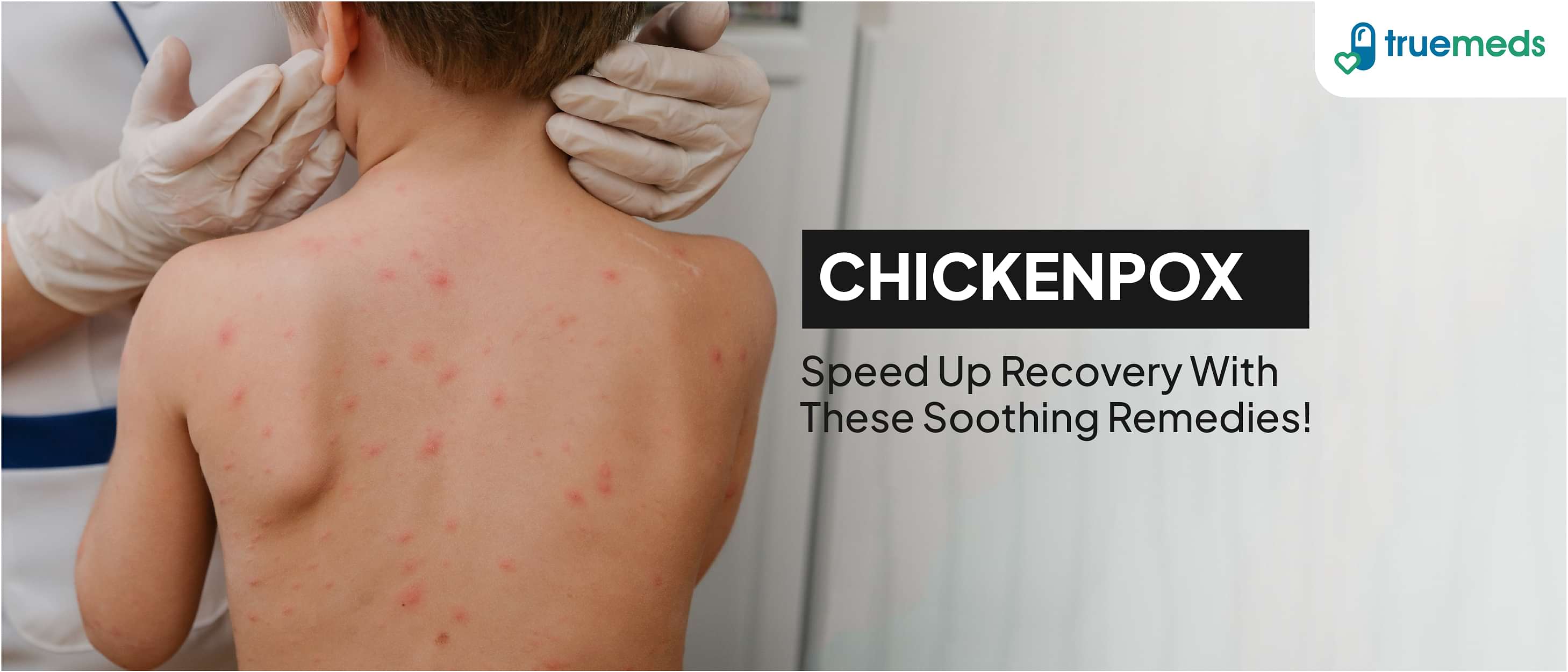 Effective Chickenpox Treatment at Home: Chicken Pox Home Remedies, Prevention and Much More