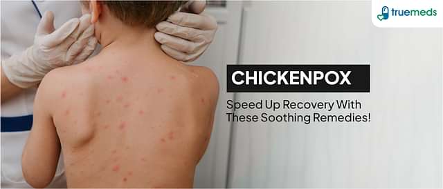 Effective Chickenpox Treatment at Home: Chicken Pox Home Remedies, Prevention and Much More
