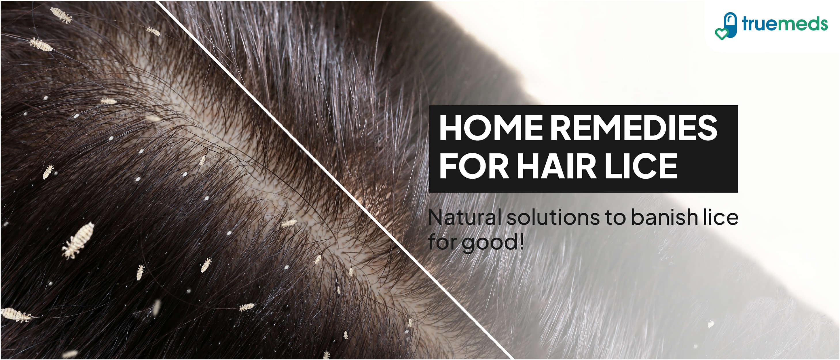 6 Effective Home Remedies for Hair Lice Treatment