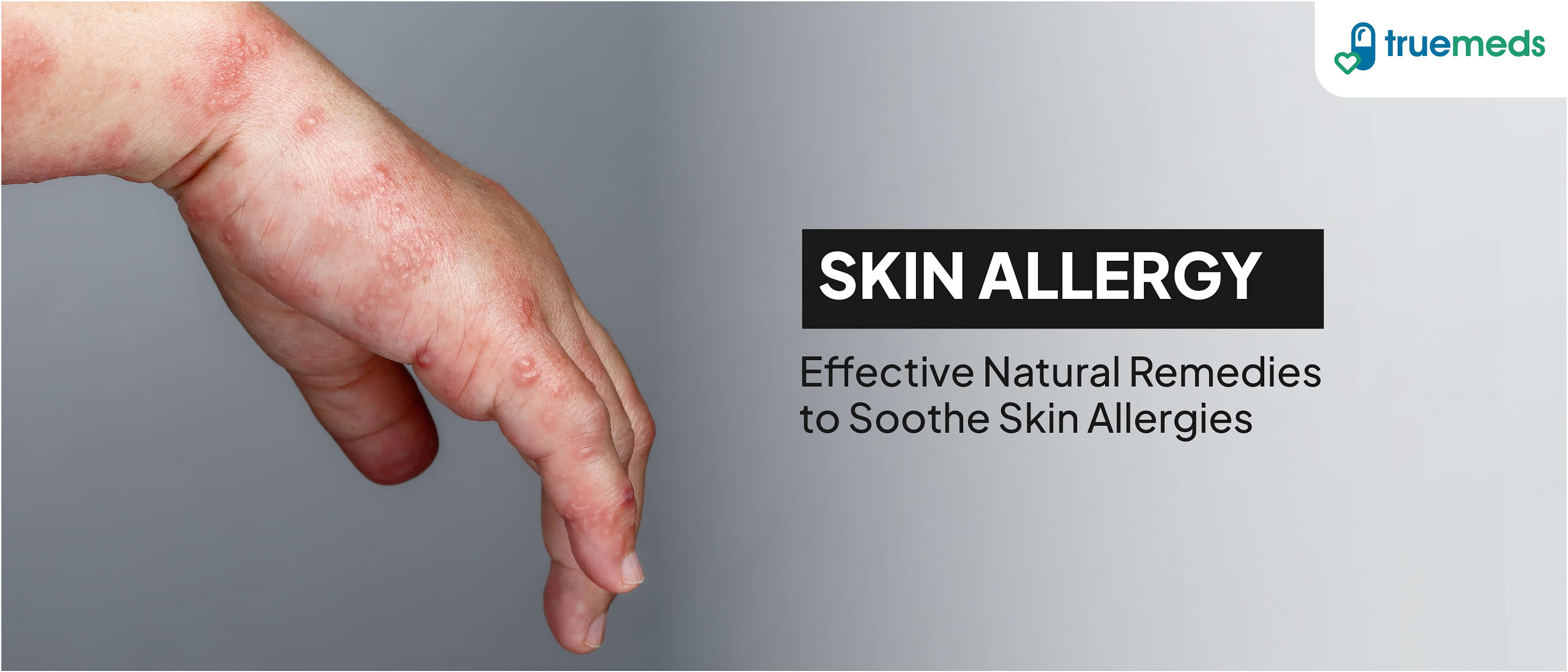 Natural Home Remedy for Skin Allergy