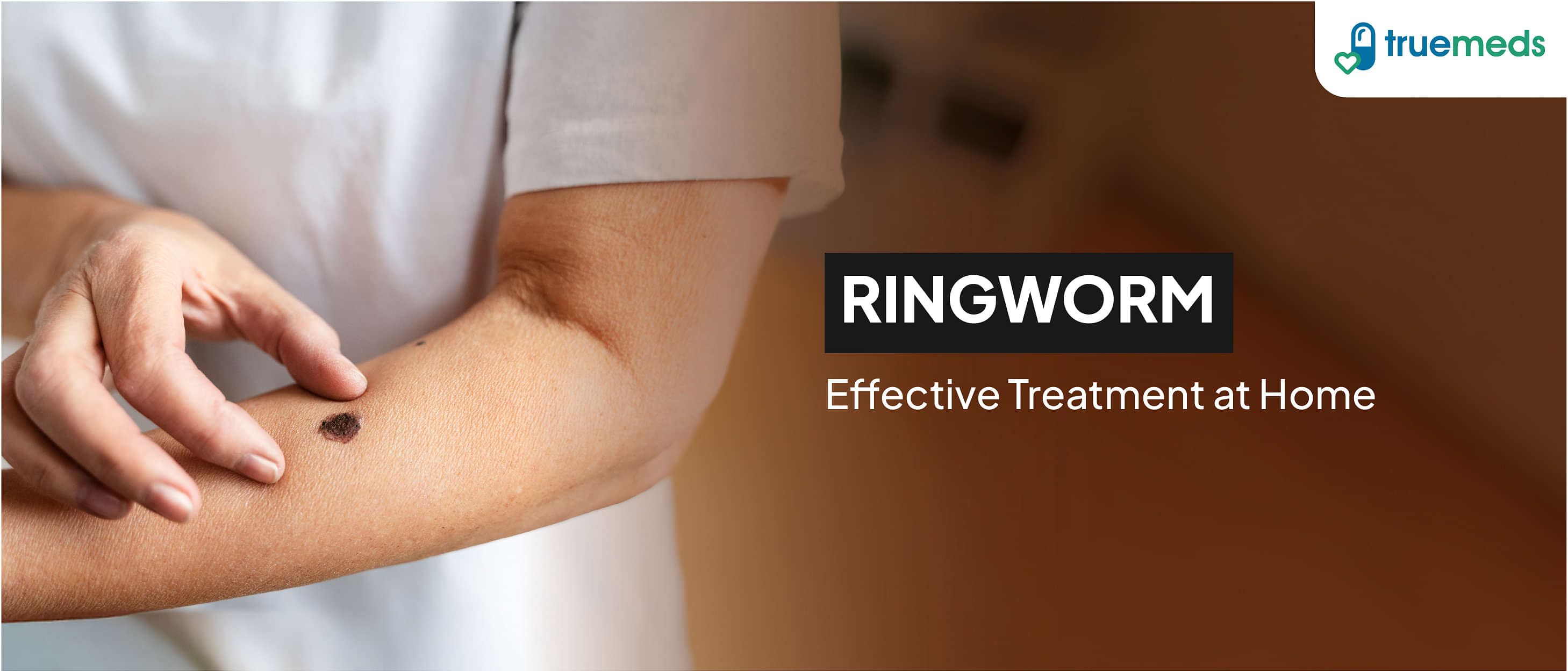 Effective Ringworm Treatments: Home Remedies and More