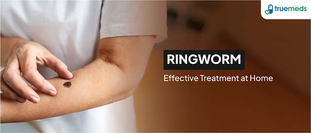 Effective Ringworm Treatments: Home Remedies and More