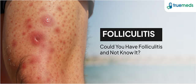 Folliculitis: Causes, Symptoms and Treatments