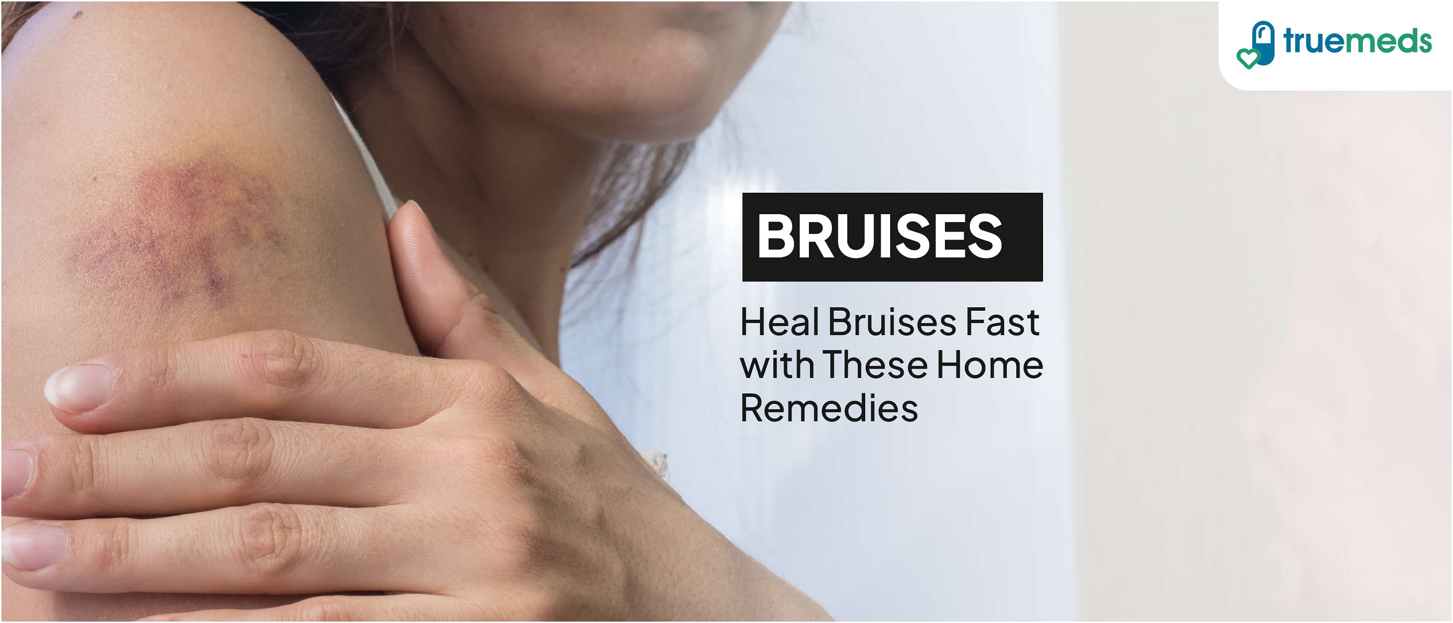 Home Remedies for bruises