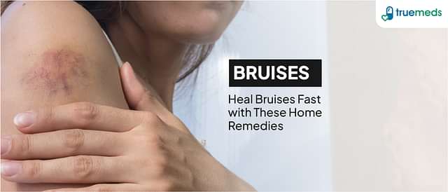 Home Remedies for Bruises