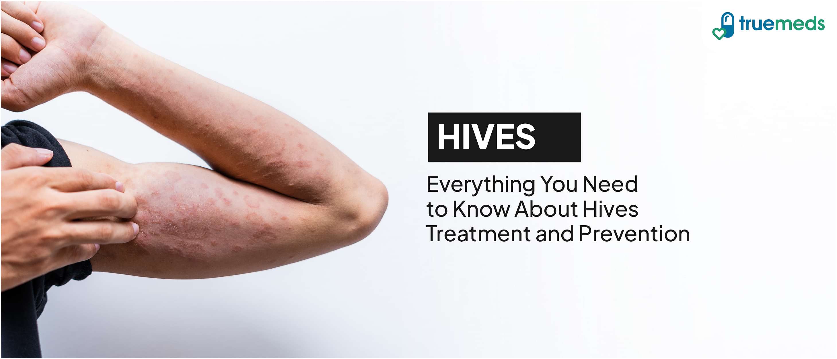 Hives causes, prevention and natural remedies