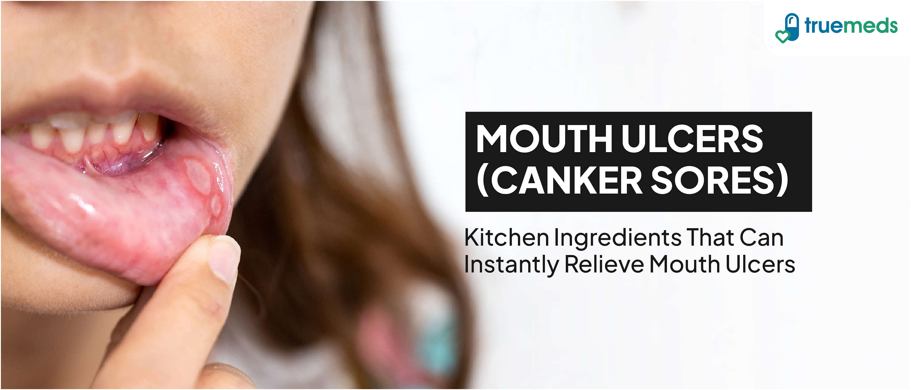 Home Remedies Treatment for Mouth Ulcer (Canker Sores)