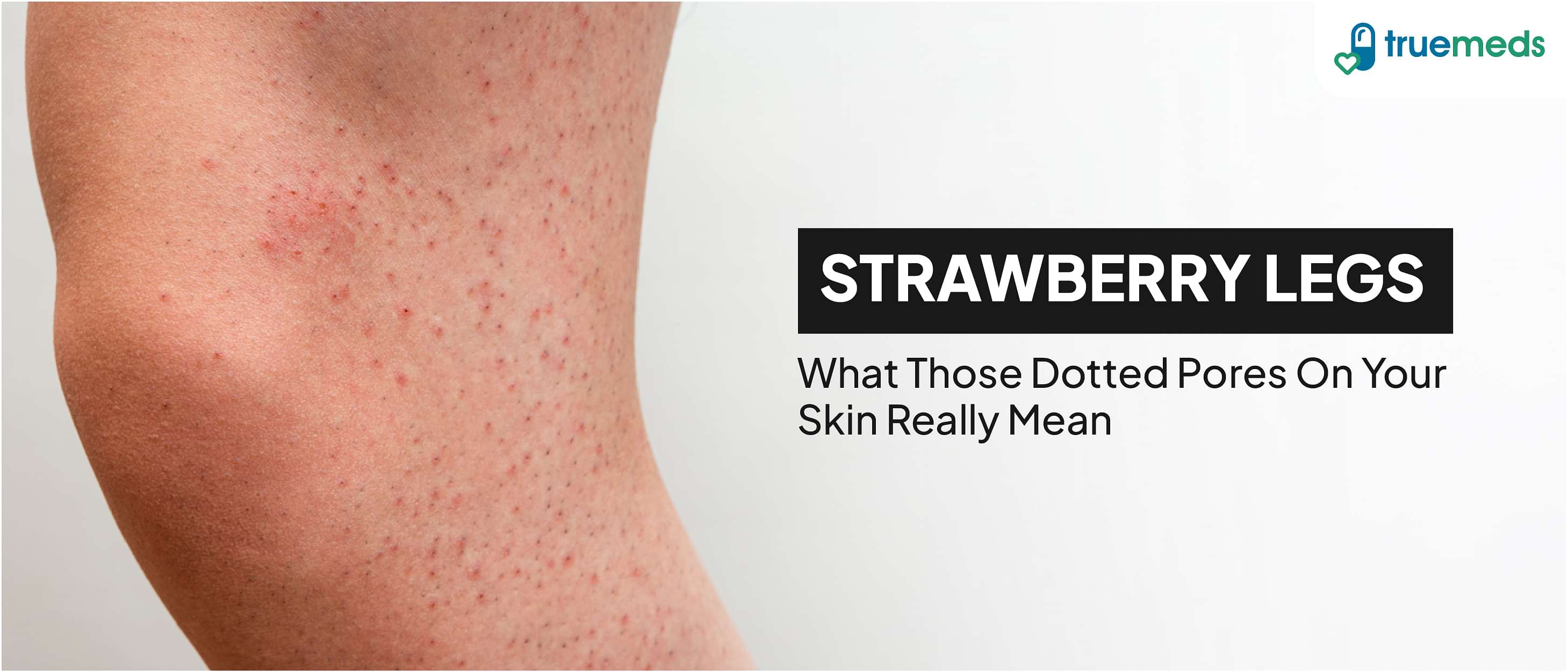 How to Get Rid of Strawberry Legs: Causes, Treatments, and Home Remedies