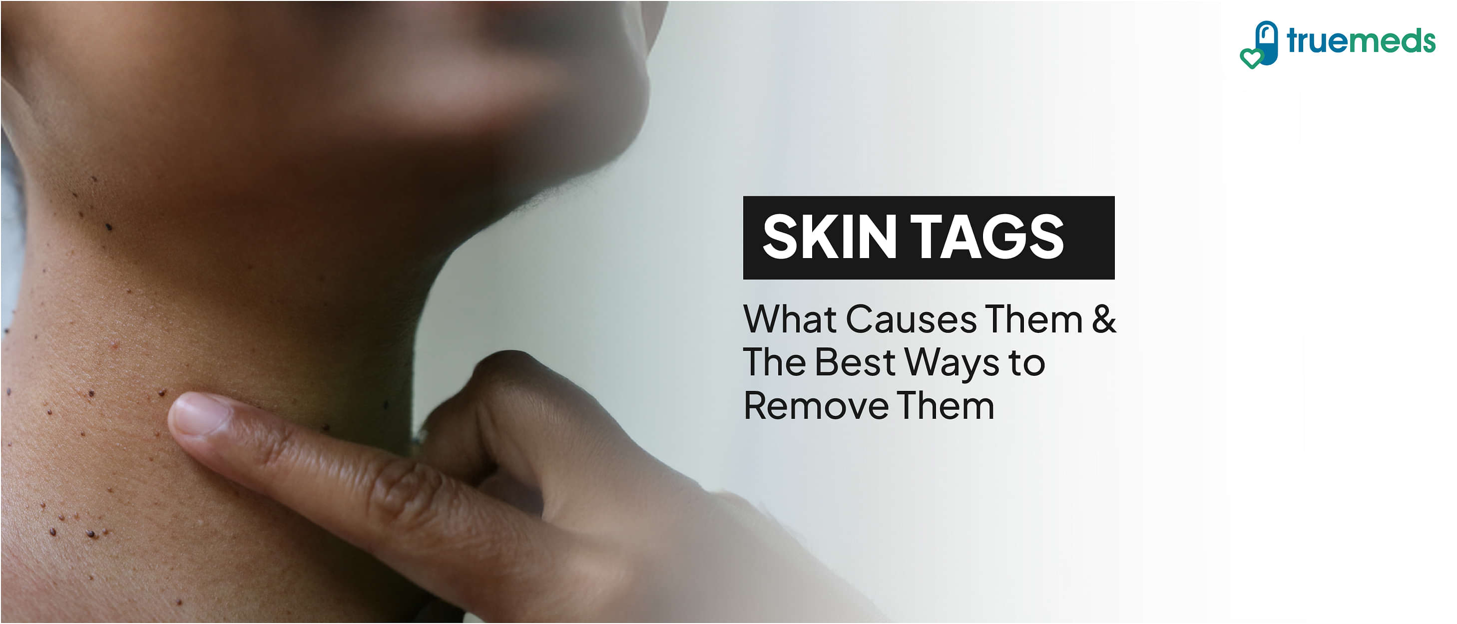 How to Remove Skin Tags: Causes, Treatments &amp; Home Remedies