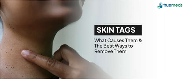 How to Remove Skin Tags: Causes, Treatments &amp; Home Remedies