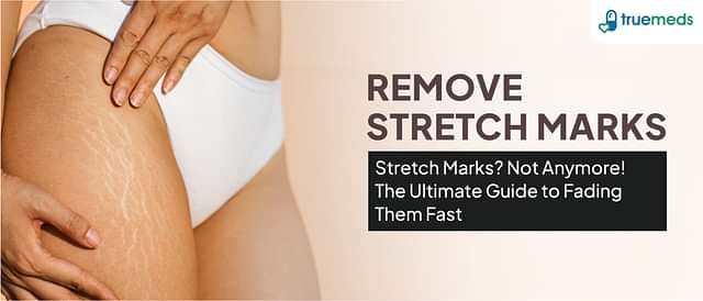 How to Remove Stretch Marks Permanently: Home Remedies and Tips