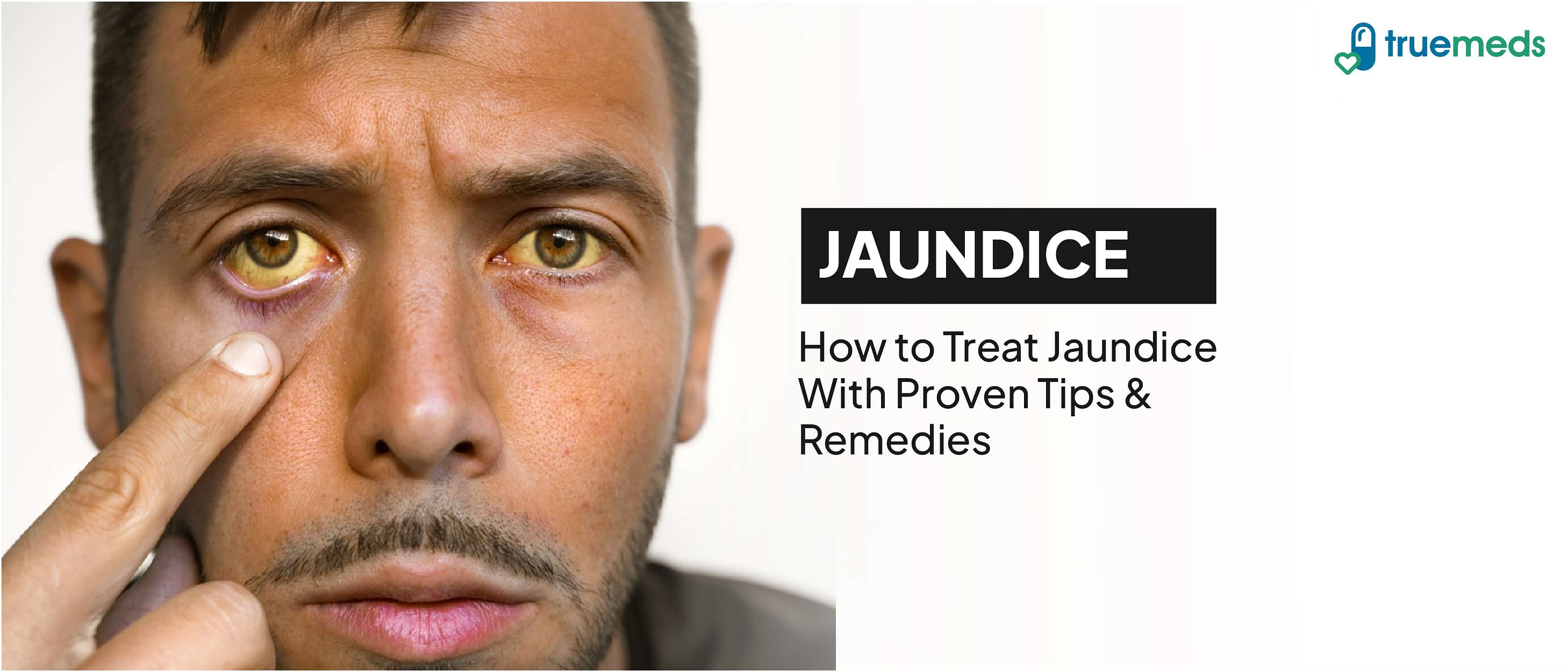 Jaundice: Types, Causes, Symptoms, and Treatment