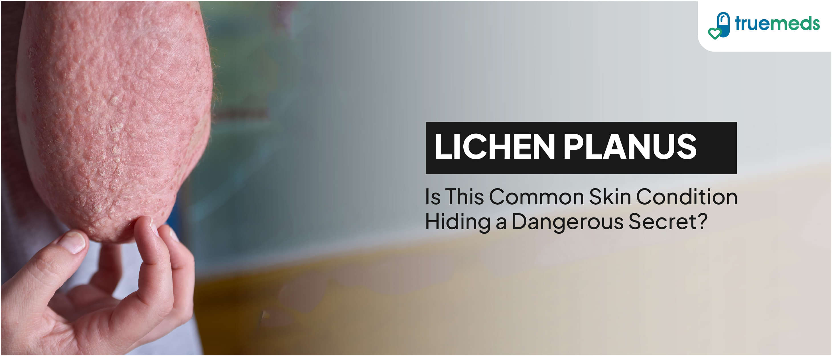 Lichen Planus Overview, Home Remedies and More