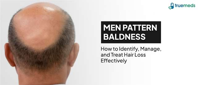 Male Pattern Baldness: Causes, Symptoms, Stages, and Treatment