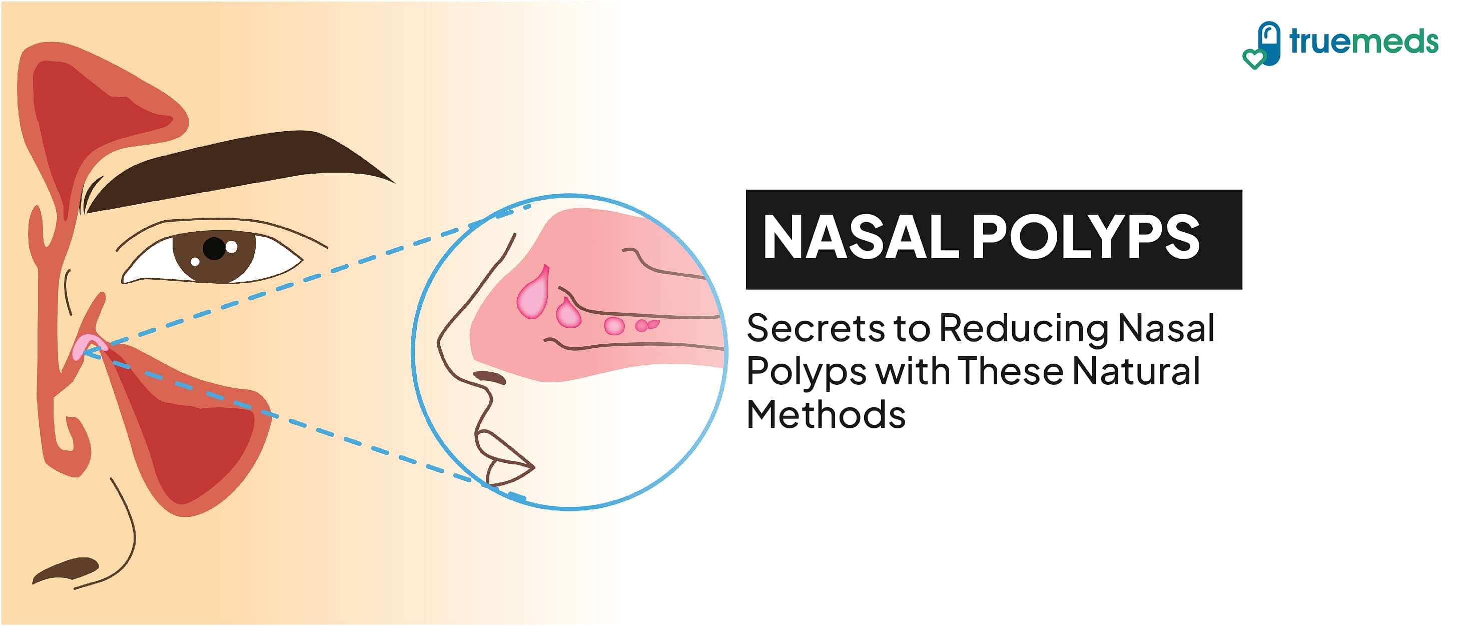 Nasal polyps: causes, symptoms and home remedies