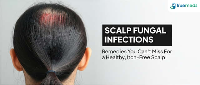 Natural Scalp Fungus Treatment: Top 10 Effective Home Remedies