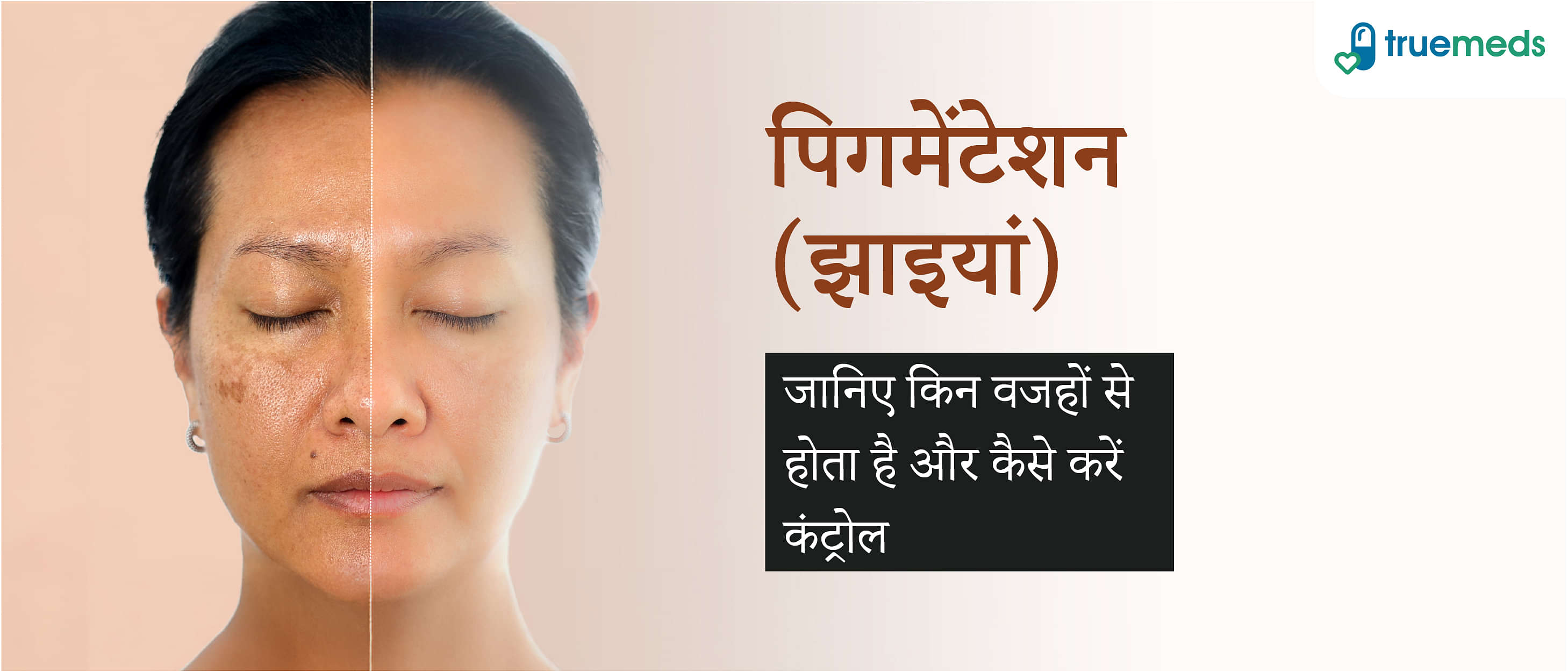 पिगमेंटेशन (झाइयां) के लक्षण, कारण, और घरेलू इलाज