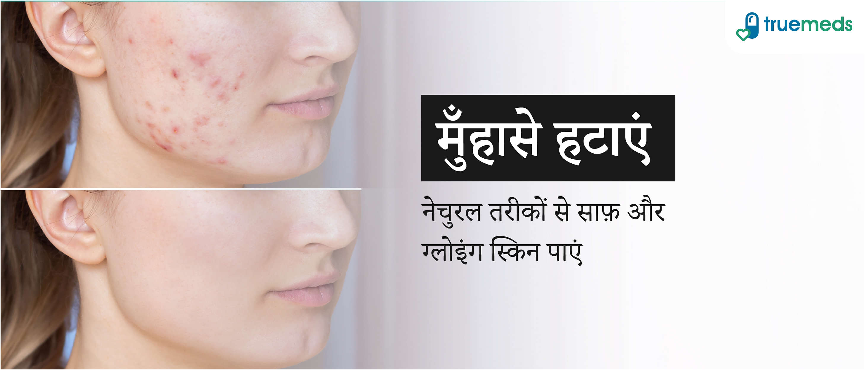 मुँहासों और पिंपल्स से छुटकारा पाने के 7 असरदार घरेलू उपाय