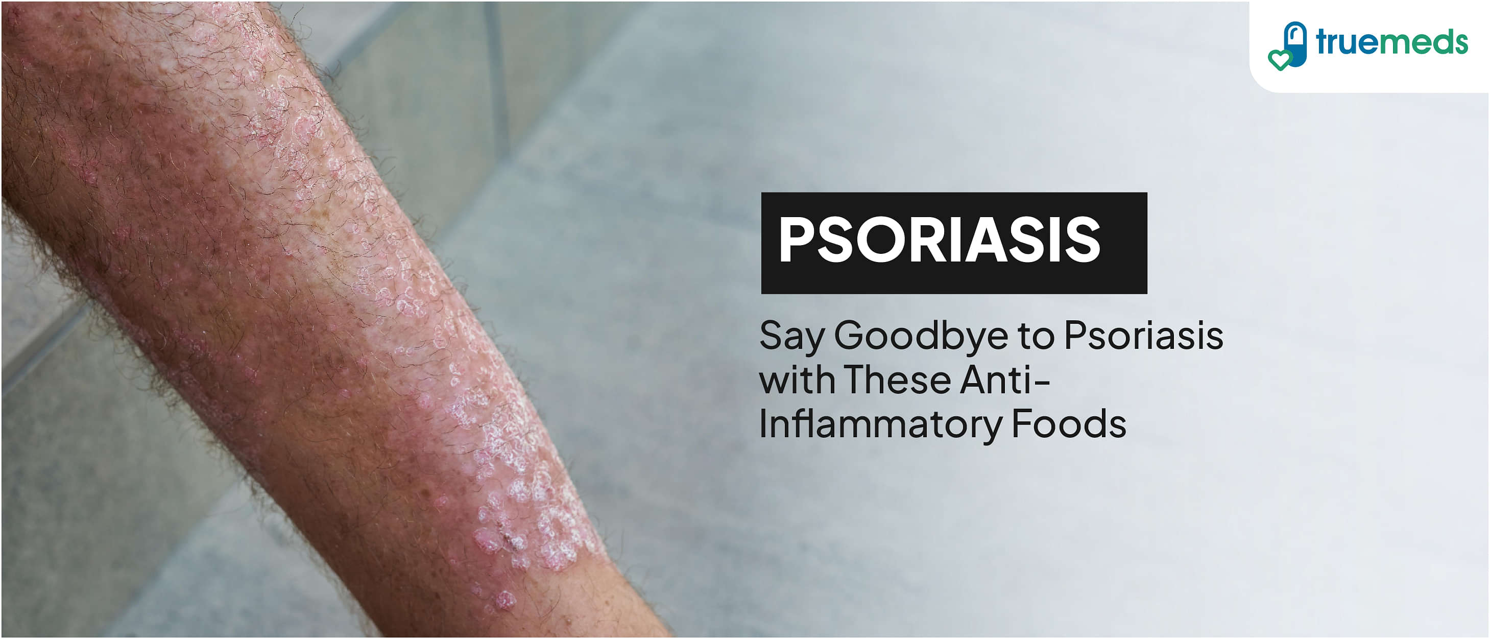 Psoriasis Diet: What Foods To Eat And Avoid