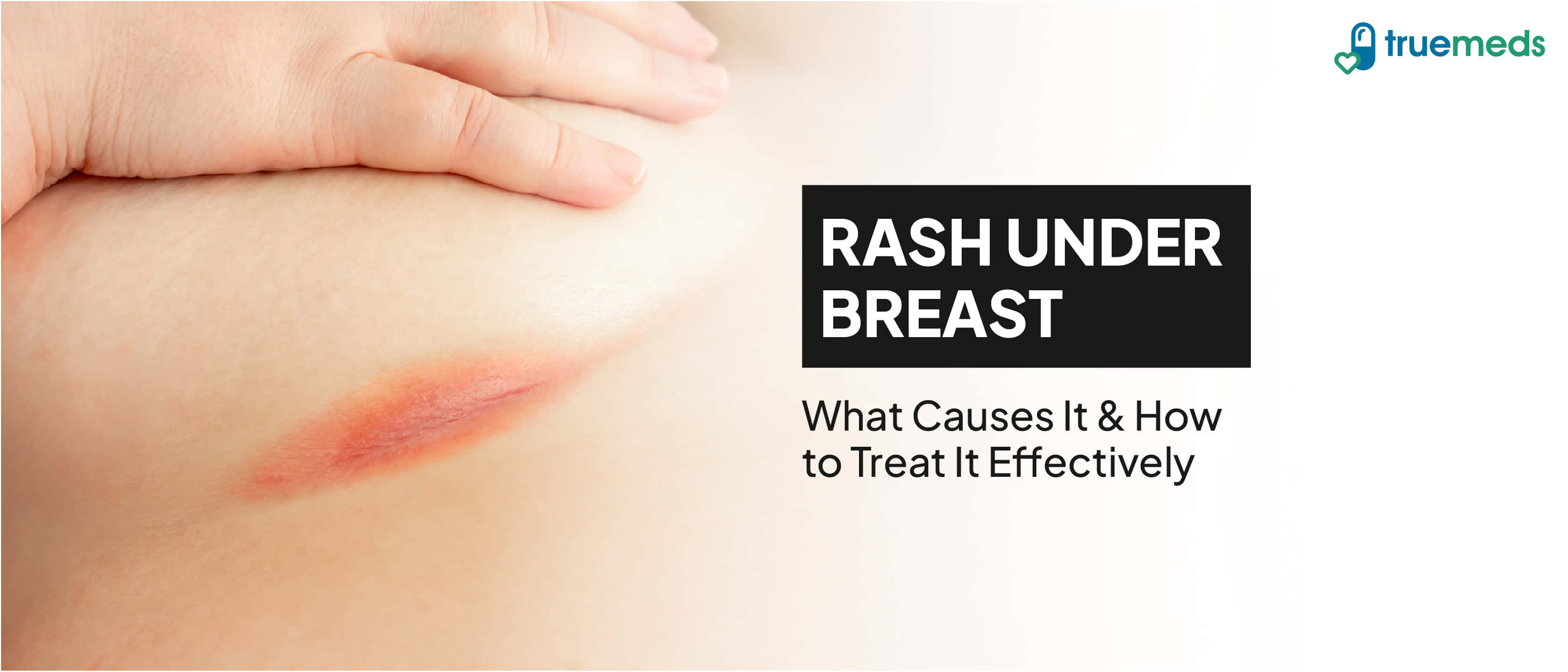 Sweat Rash Intertrigo Rash Under The Breast Treatment – GKAAJE