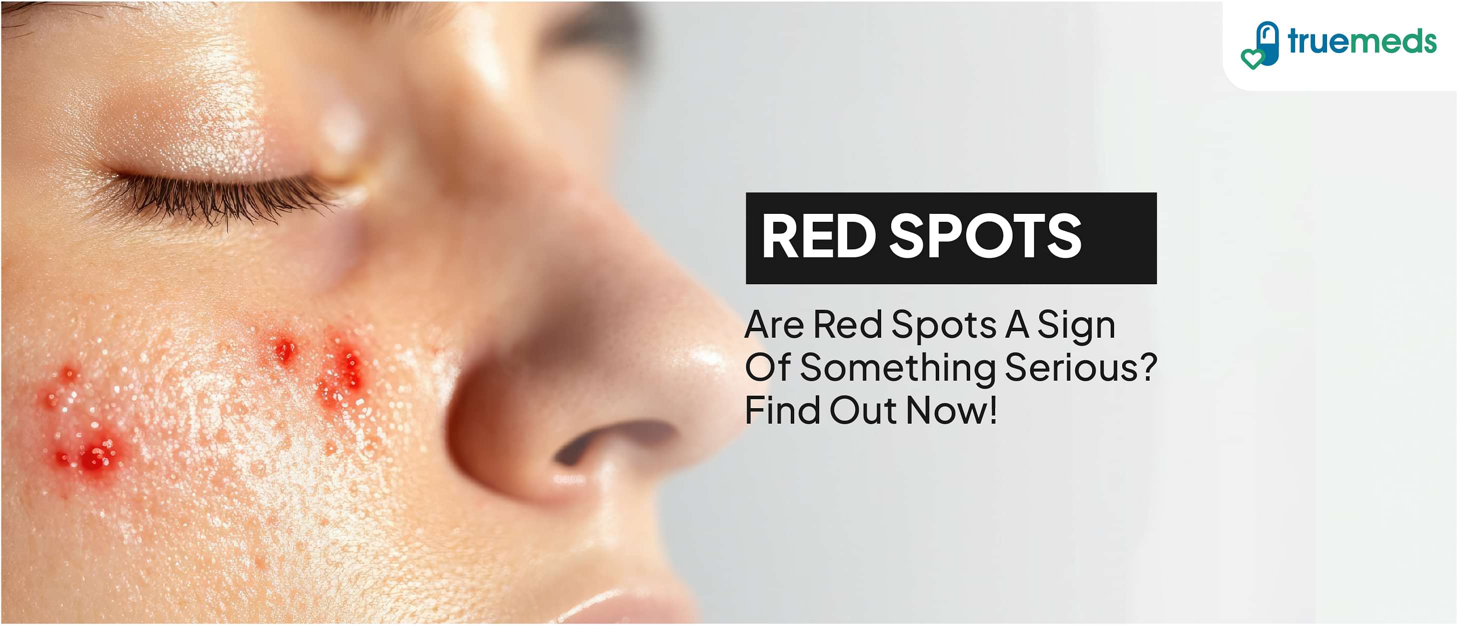 Red Spots on Skin: Types, Causes, Symptoms, and How to Treat Them Effectively