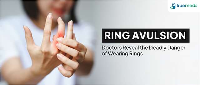 Ring Avulsion: Causes, Prevention, and Treatment