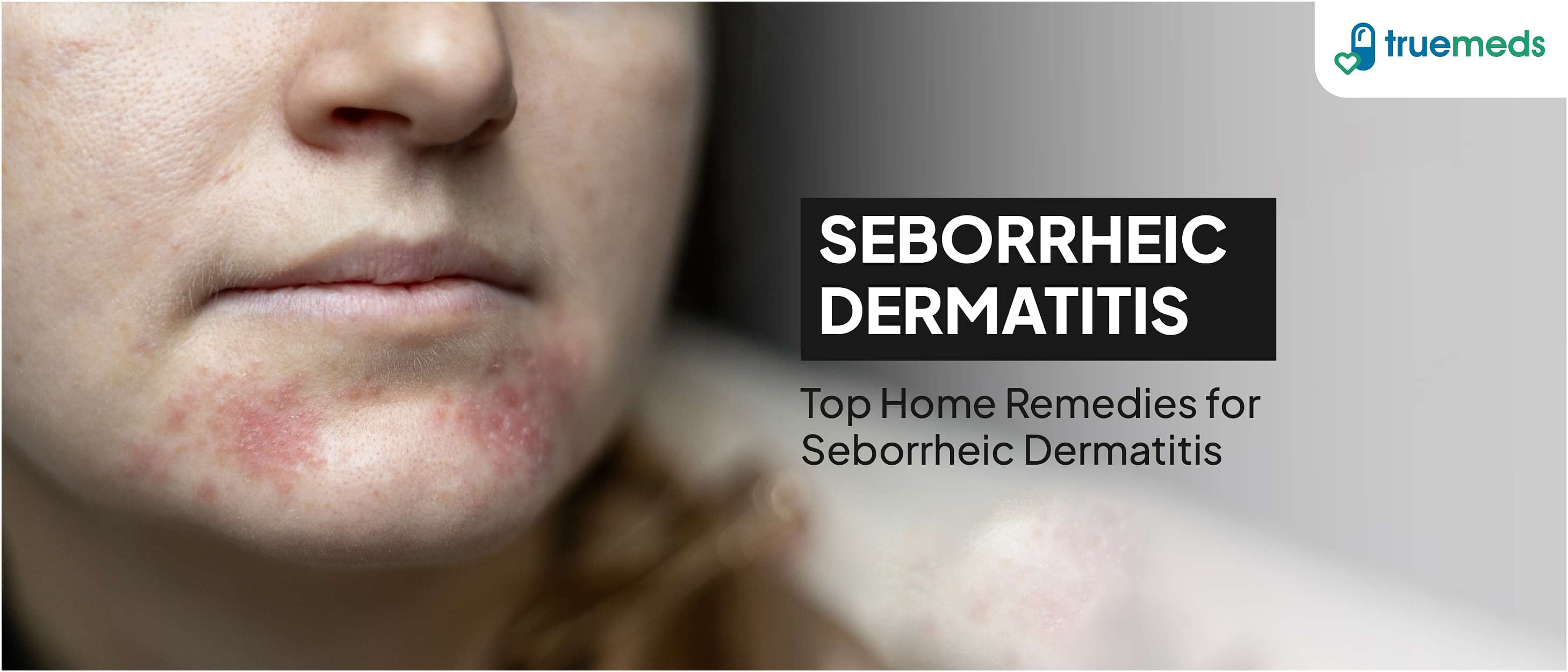 Seborrheic Dermatitis: Diet And Natural Remedies