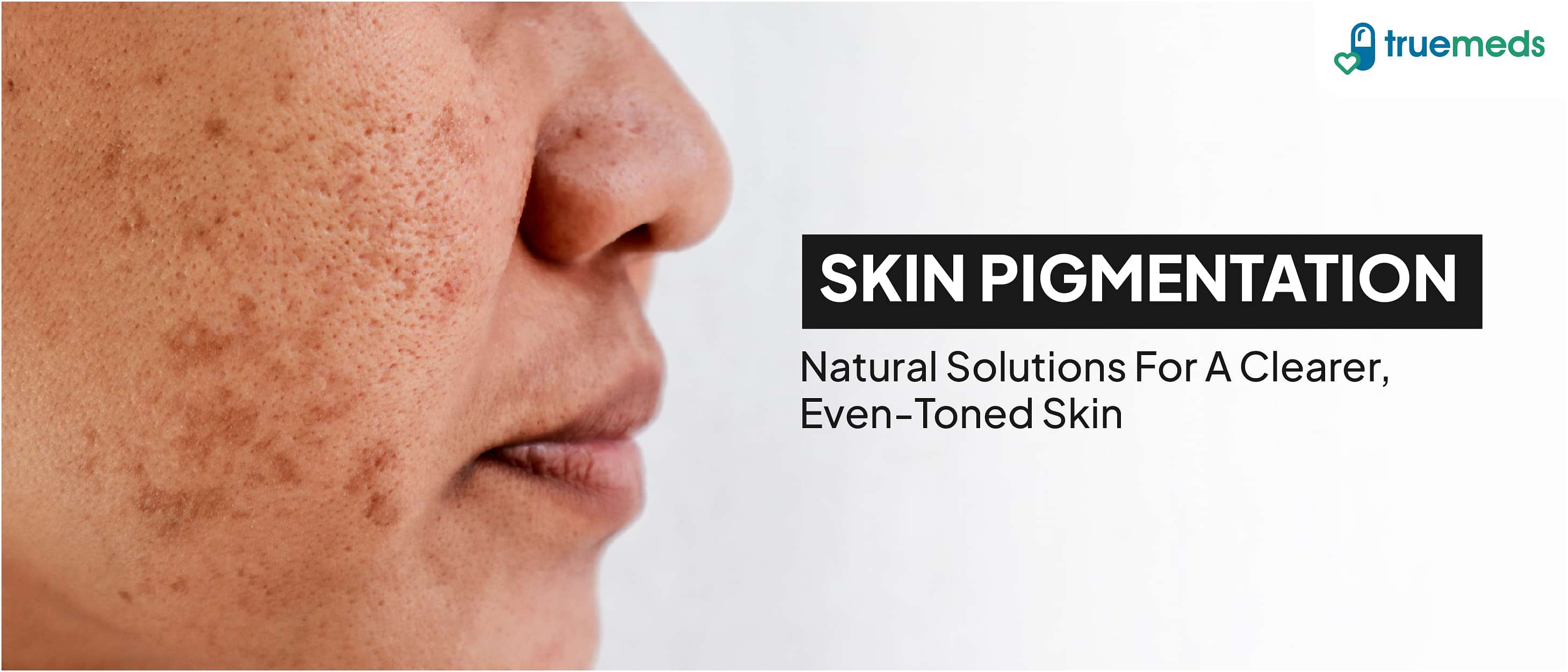 Skin Pigmentation: Overview, and Natural Home Remedies