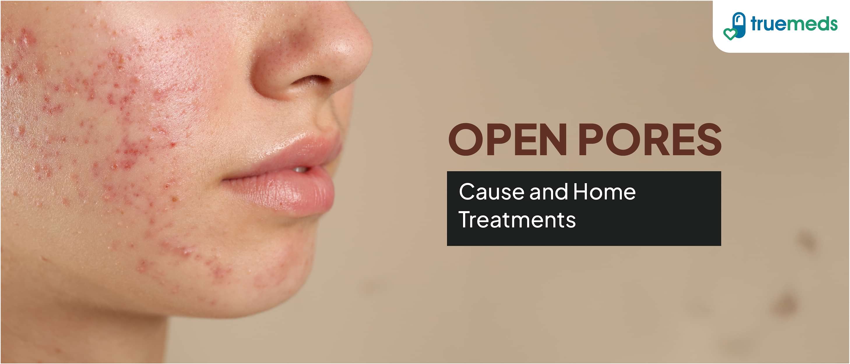 The Ultimate Guide to Remove Open Pores at Home From Its Causes to Treatment