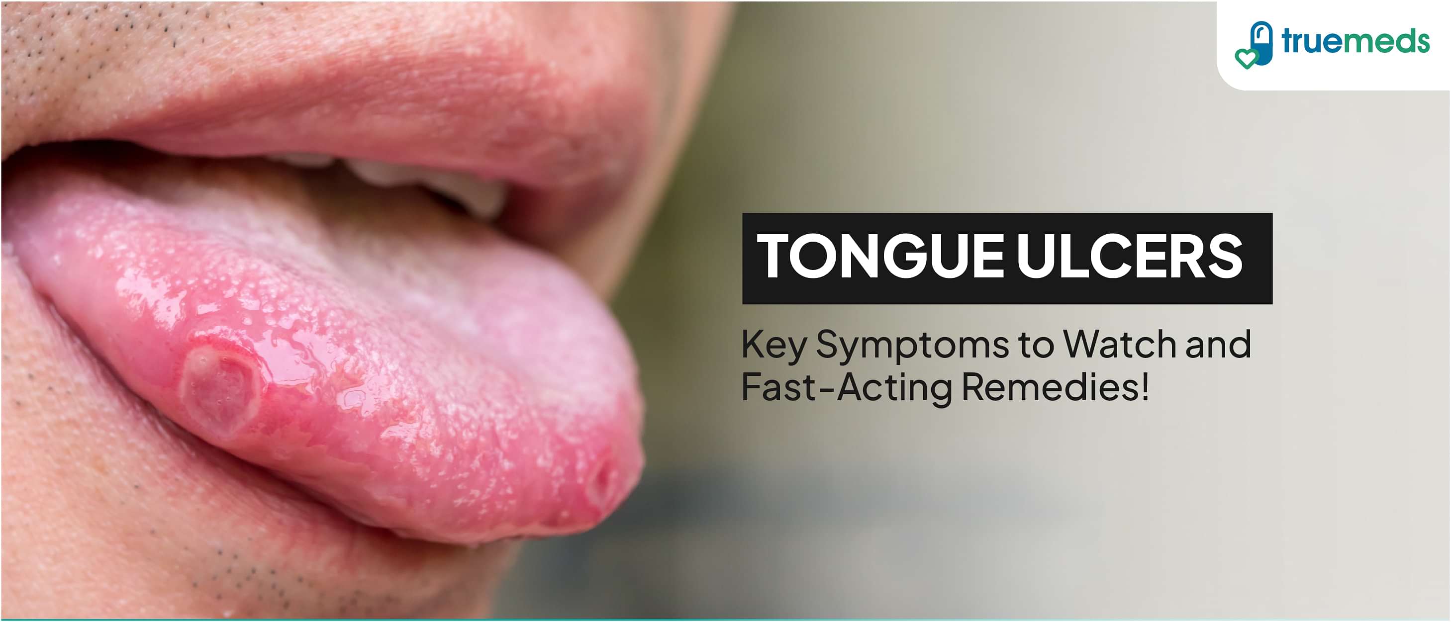 Tongue Ulcers: Causes, Symptoms &amp; Treatments