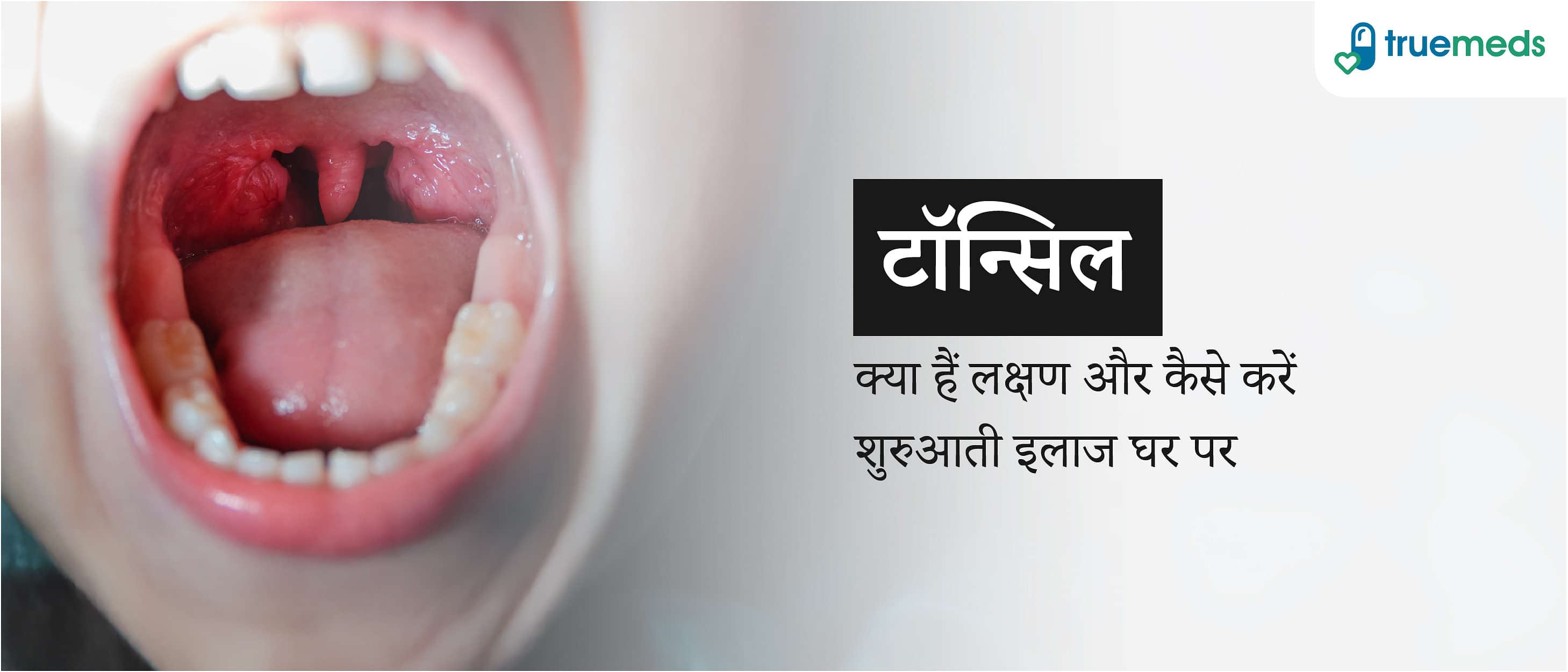 टॉन्सिल: लक्षण, कारण और असरदार घरेलू उपचार