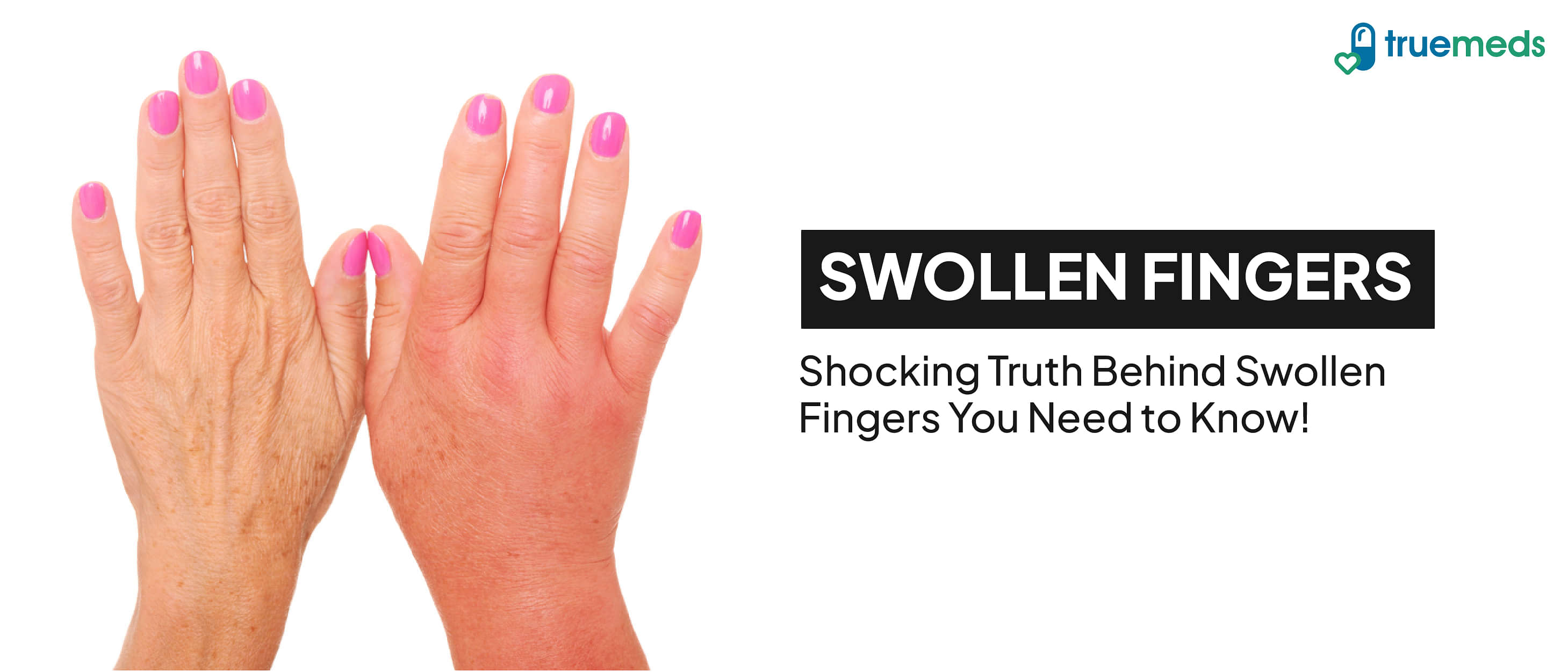 What Causes Swollen Fingers and How to Treat Them