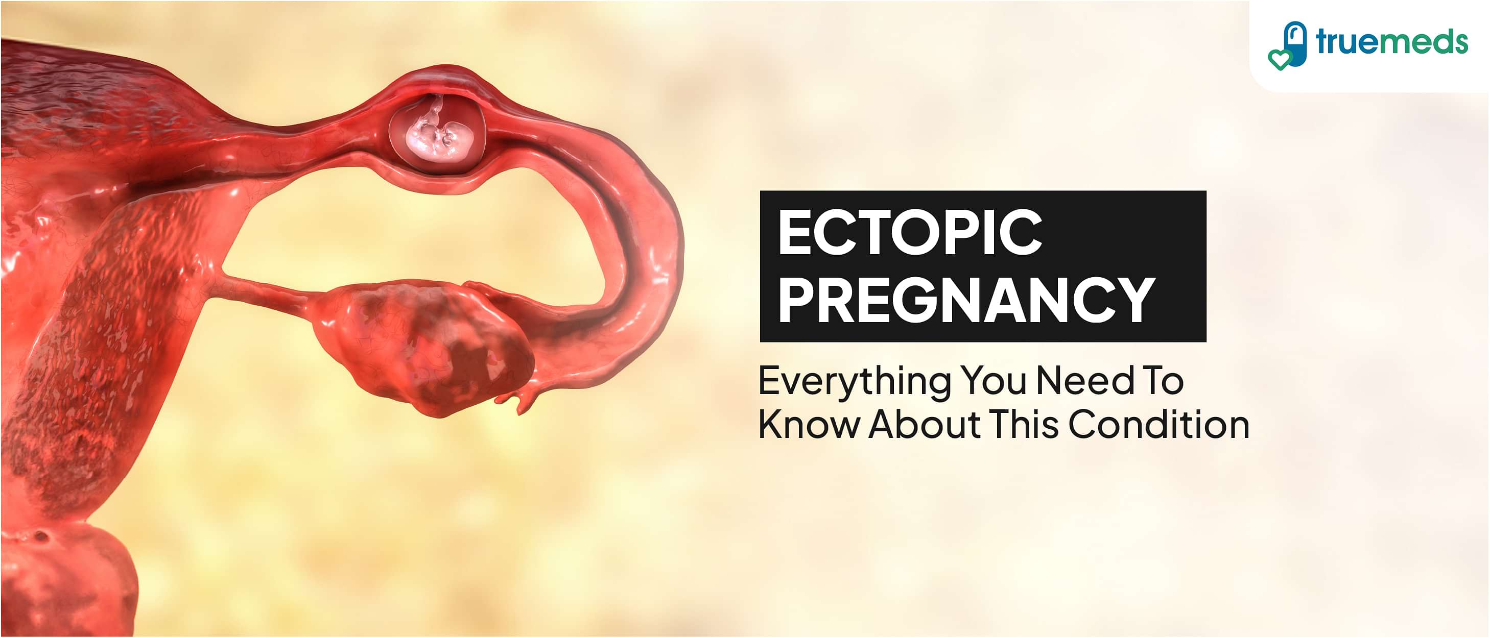 What is Ectopic Pregnancy? Symptoms, Causes, and Management Tips