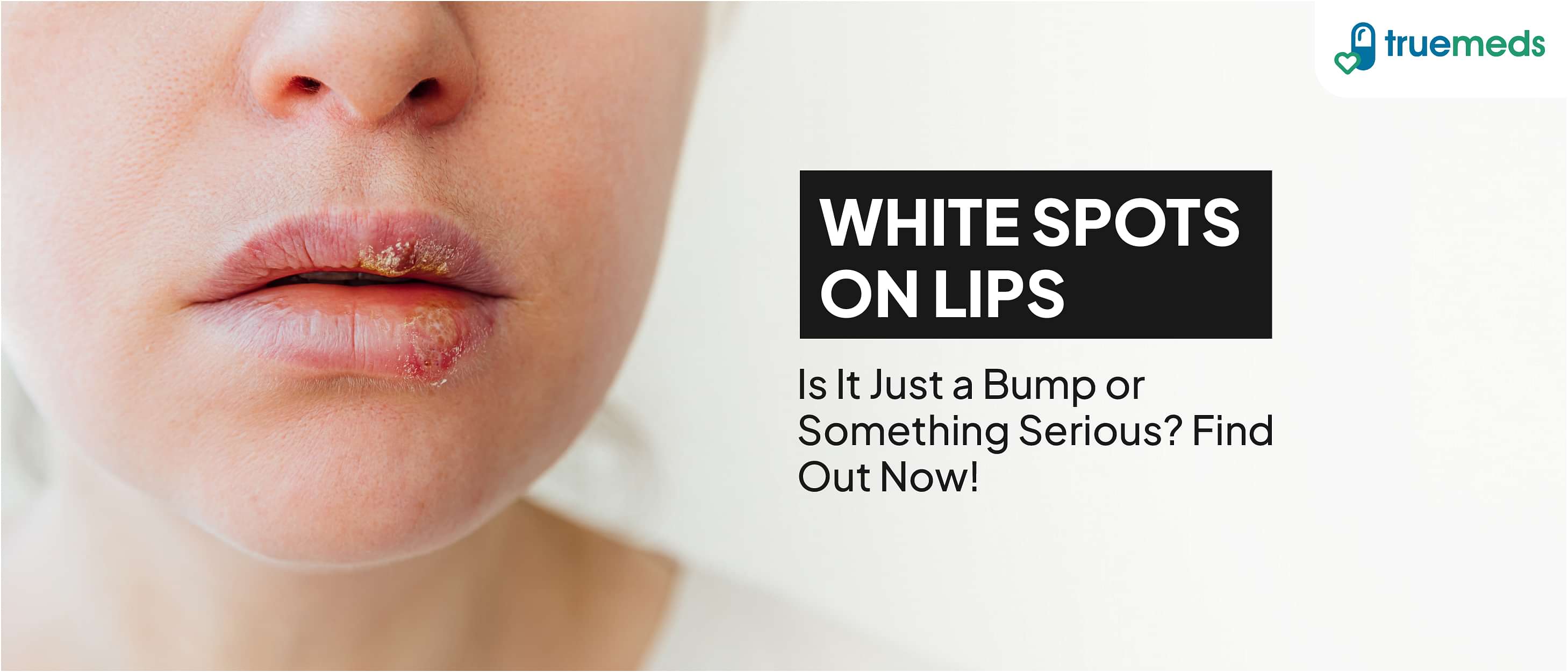 White Spots on Lips: Causes and Treatments