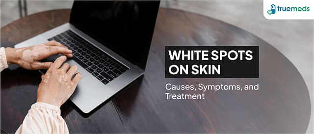 White Spots on Skin: Causes, Symptoms, and Treatment