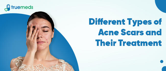 Different Types of Acne Scars and Their Treatment